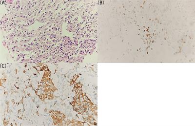 Recognizing Tumor Origin for Lymphoid Tumor of Unknown Primary via Total-Body PET/CT Scan—Case Report